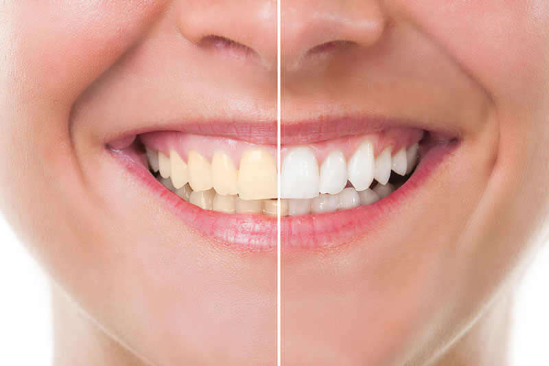 Teeth Whitening - Downey Beautiful Smile, Downey Dentist